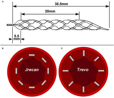 The Jrecan Device: Preclinical Data of a Novel Thrombectomy Device in Acute Thromboembolism Model of Beagle Dogs